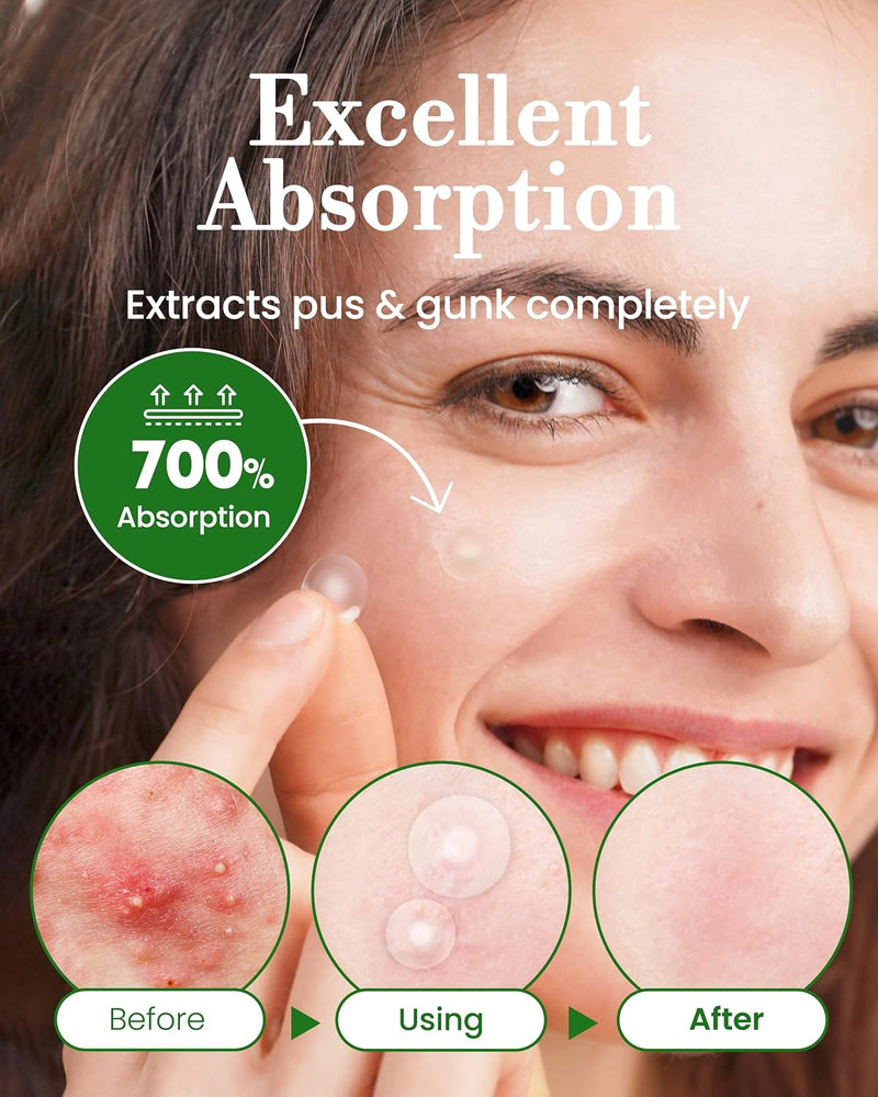 Troubless Invisible Pimple Patch Classic, 96 Patches (2 Sizes) – Ultra Thin Hydrocolloid Spot Treatment for Daytime Use, Easy Peel, Fast Healing, Absorbs Oil & Impurities, For Acne-Prone Skin